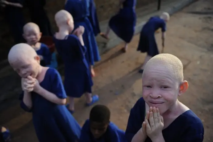 El drama de ser albino en Africa (info y fotos)