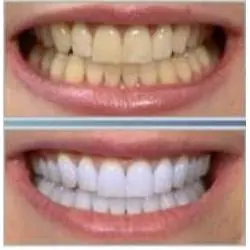Mitos y verdades del blanqueamiento dental.