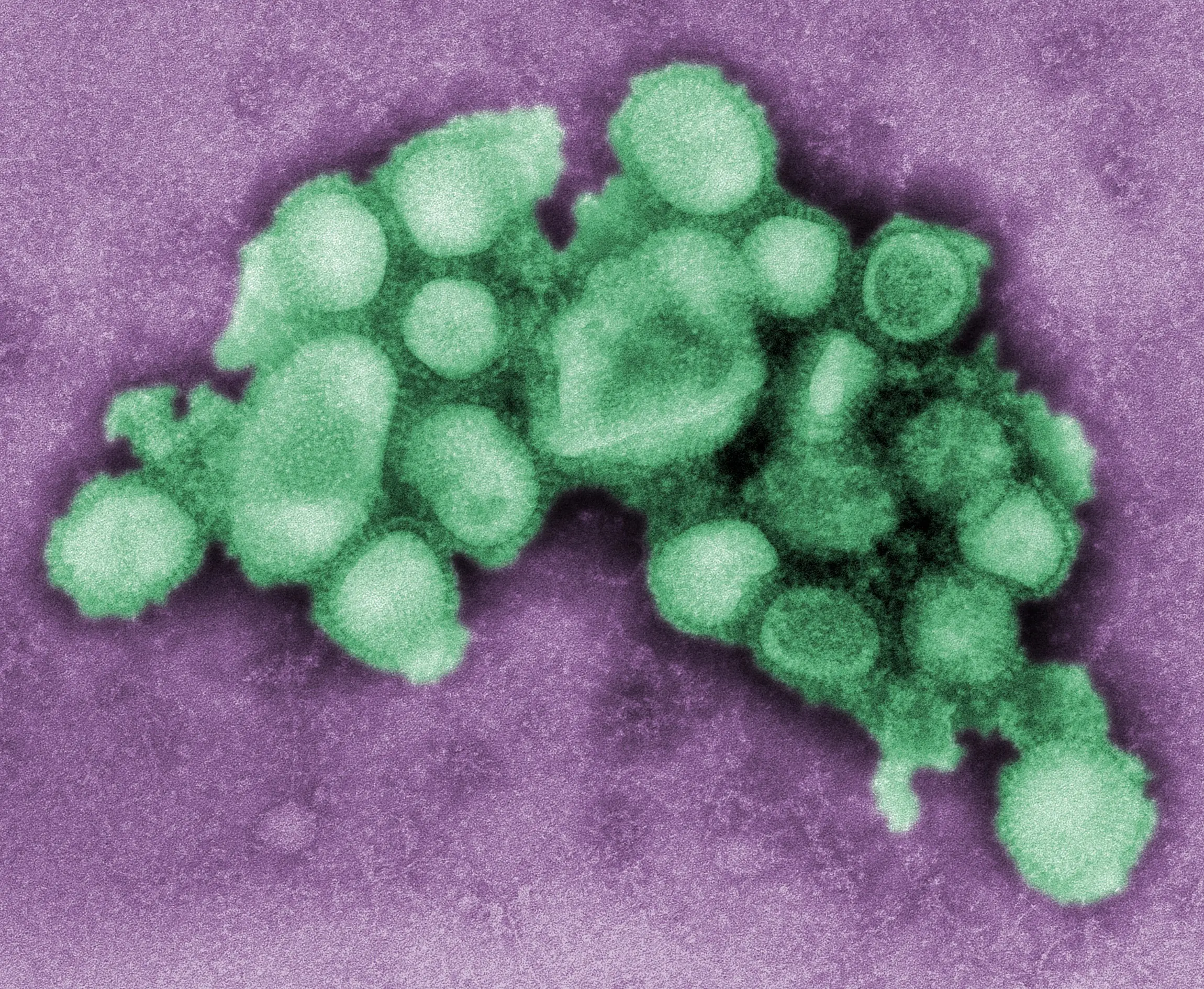 influenza A (H1N1) (gripe porcina)