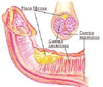 Masajes para corregir pene curvo