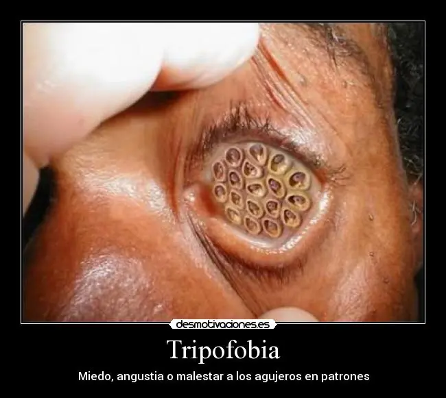tripofobia