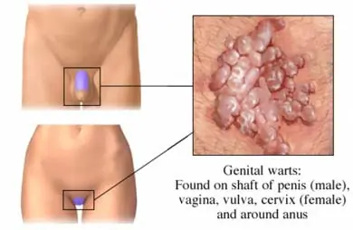 Virus del papiloma humano en Hombres (HPV o VPH)