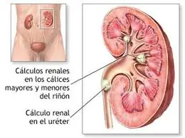 calculos renales , que son ?? como se previene??
