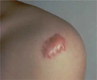 Peligro en la piel : Los Queloides.