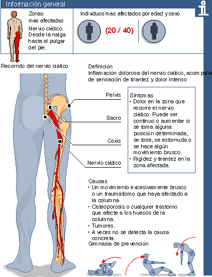 Qué es la Ciática y el Lumbago cómo puedes tratarlo