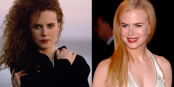 nicole kidman antes y después del Botox
