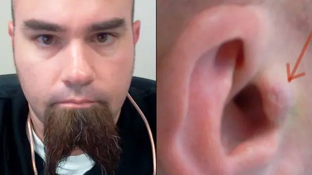 Hombre se implanta los audífonos para no ponérselos y qui