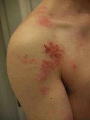 Como quitar el ardor y la picazón del herpes
