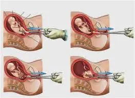 La despenalización del aborto y la violencia en todo Méxic