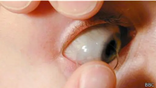 lentes de contacto que proporcionan visión telescópica