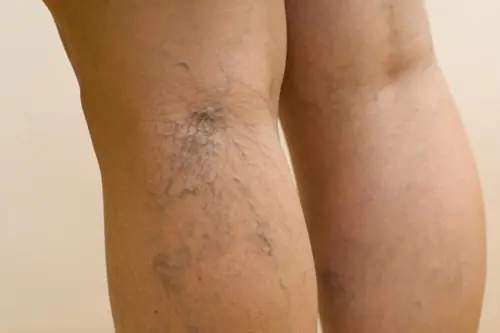 ¡Elimina las arañitas y várices de las piernas desde Casa