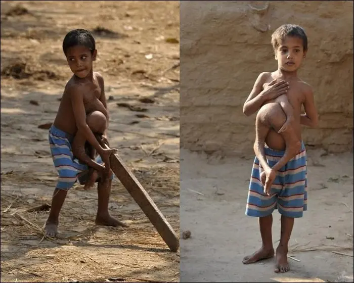 niño con cuatro pies