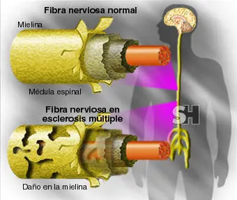 Qué es la Esclerosis Múltiple?