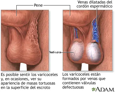 Varicocele, la sufrís?