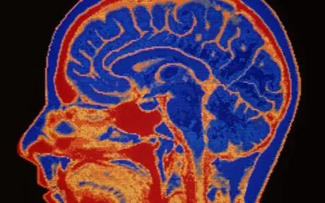 Las dietas hacen que tu cerebro se coma a sí mismo