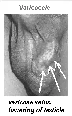 Varicocele Testicular (Muy comun en adolescentes)