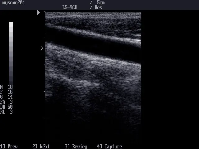 Hipertensión Arterial: Todo lo que hay que saber.