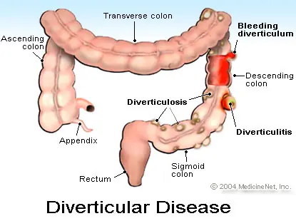 Dolores de Estomago? Puede ser Diverticulitis