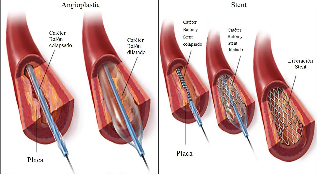 El stent cumple 25 años