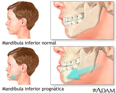 Cirugia de una Prognática! (de mandibula)