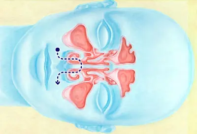 Cómo funciona la Irrigación Nasal