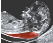 descartar sindrome down por ultrasonido.
