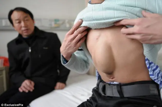 Hombre nació con el corazón en el abdomen
