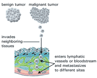 Tumores No Cancerosos Versus Tumores Cancerosos