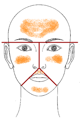 Manchas en la cara - Melasma