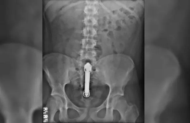 Se le atascó un vibrador y compartió la foto en Twitter
