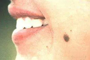 Porque tenemos o nos salen Lunares ?