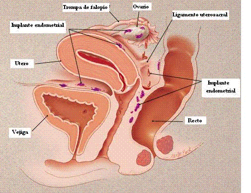 ¿Qué es la Endometriosis?