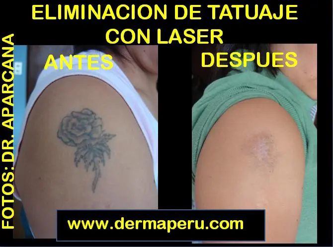 Eliminación de Tatuajes.