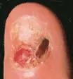 Onicofagia (comerse las uñas)