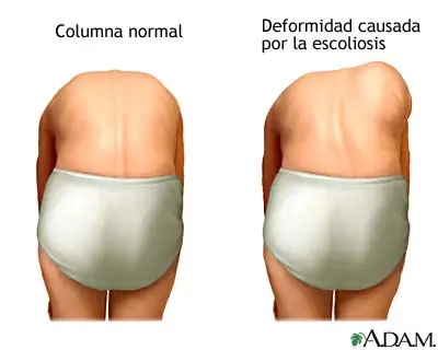 escoliosis