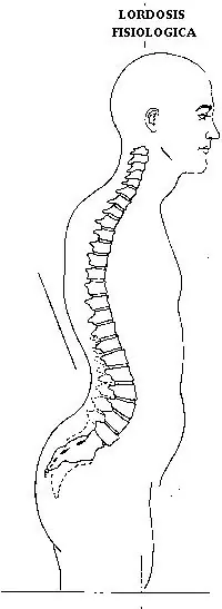 escoliosis