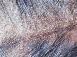 eccema seborreico (caspa) causas y tratamiento