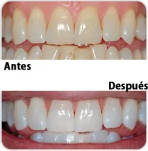 como blanquear los dientes