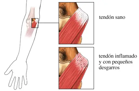 Codo de Tenista (Epicondilitis Lateral y Medial)