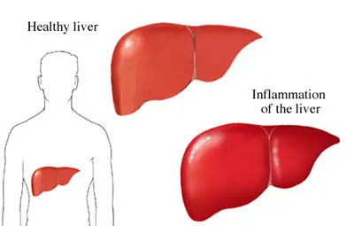 hepatitis b