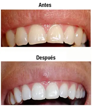 ¿En qué consiste el blanqueamiento dental?