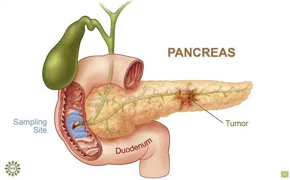 El Cancer De Pancreas ¿Que es? y Como prevenirlo