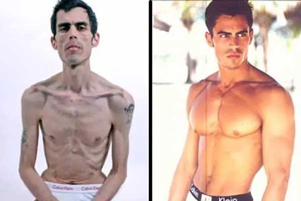 anorexia