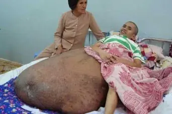 Extraen Tumor De 90 Kg