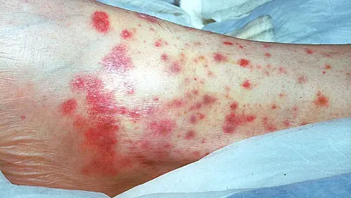 Vasculitis..Una enfermedad poco conocida