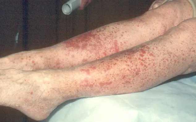 Vasculitis..Una enfermedad poco conocida