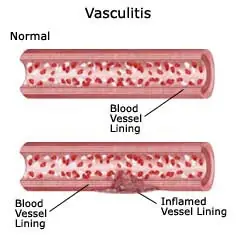 Vasculitis..Una enfermedad poco conocida