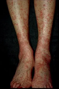 Vasculitis..Una enfermedad poco conocida