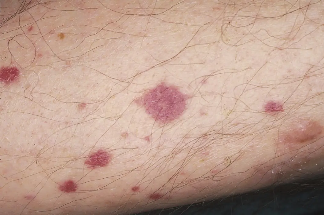 Vasculitis..Una enfermedad poco conocida