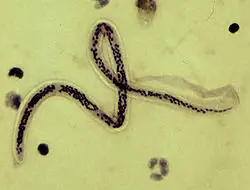 Elefantiasis la enfermedad deformante (imagenes fuertes)
